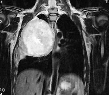 Figure 5: MRI sagittal plane showing antero-posterior extension of tumor
